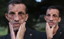 Türkiye’nin ilk yüz nakliyle hayatı değişen Acar’dan anlamlı çağrı