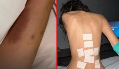 Lyme hastalığıyla mücadele eden Bella Hadid, moraran vücudunu paylaştı