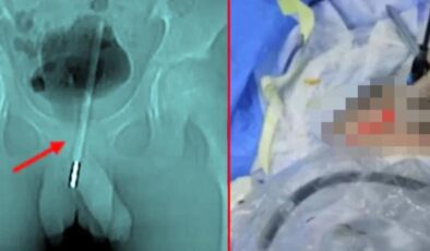 Küçük çocuğun mastürbasyon yapmak için cinsel organına soktuğu cisim doktorların ağzını açık bıraktı